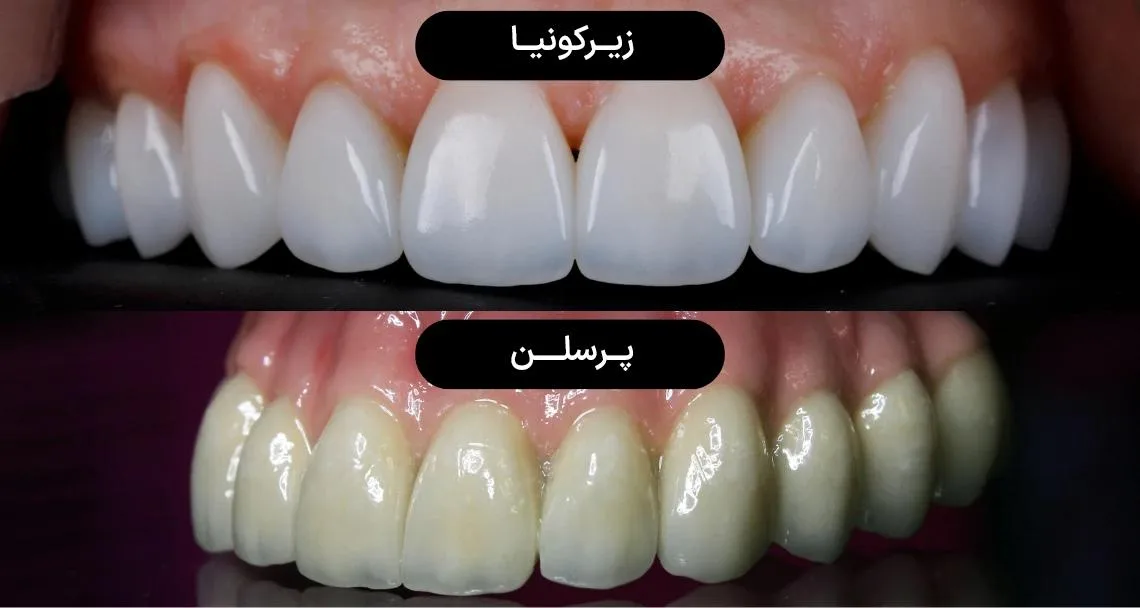 مقایسه روکش‌های زیرکونیا و پرسلن