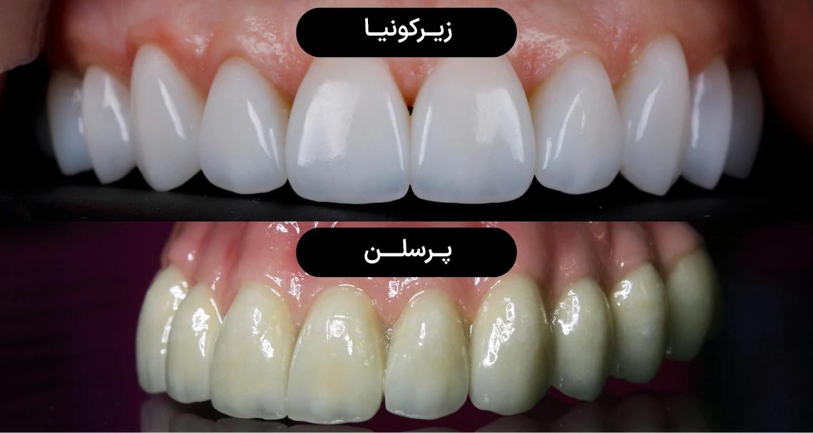 مقایسه روکش‌های زیرکونیا و پرسلن
